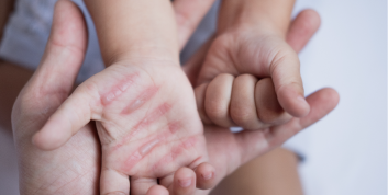 Burn & Trauma scars