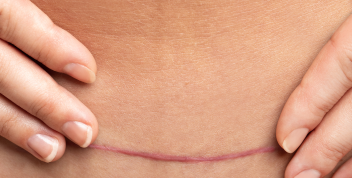C-section scars