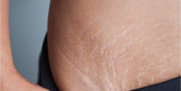 Stretch marks