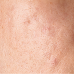 Surgery scars