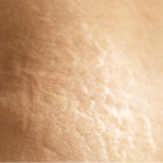 Surgery scars