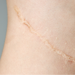 Surgery scars