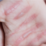 Surgery scars
