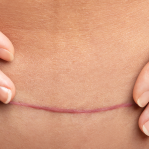Surgery scars
