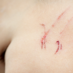 Surgery scars
