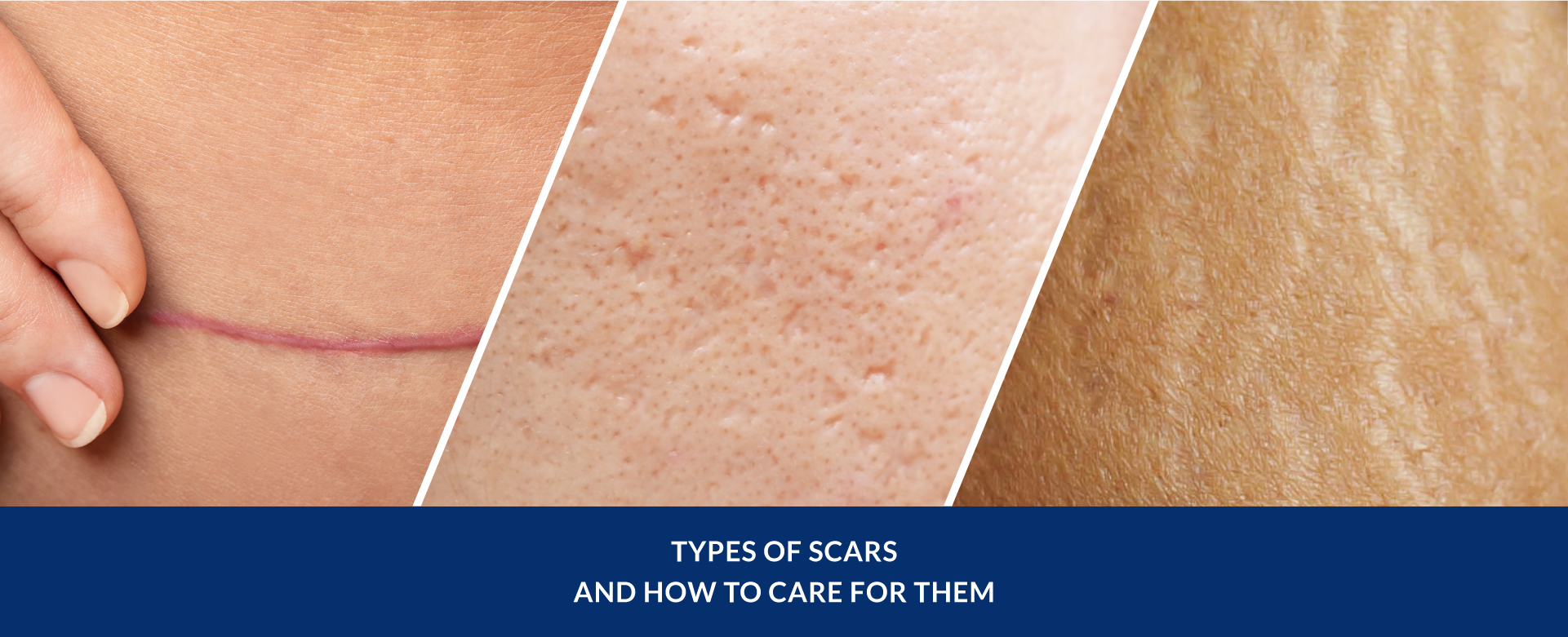 Kelo.Cell Scars